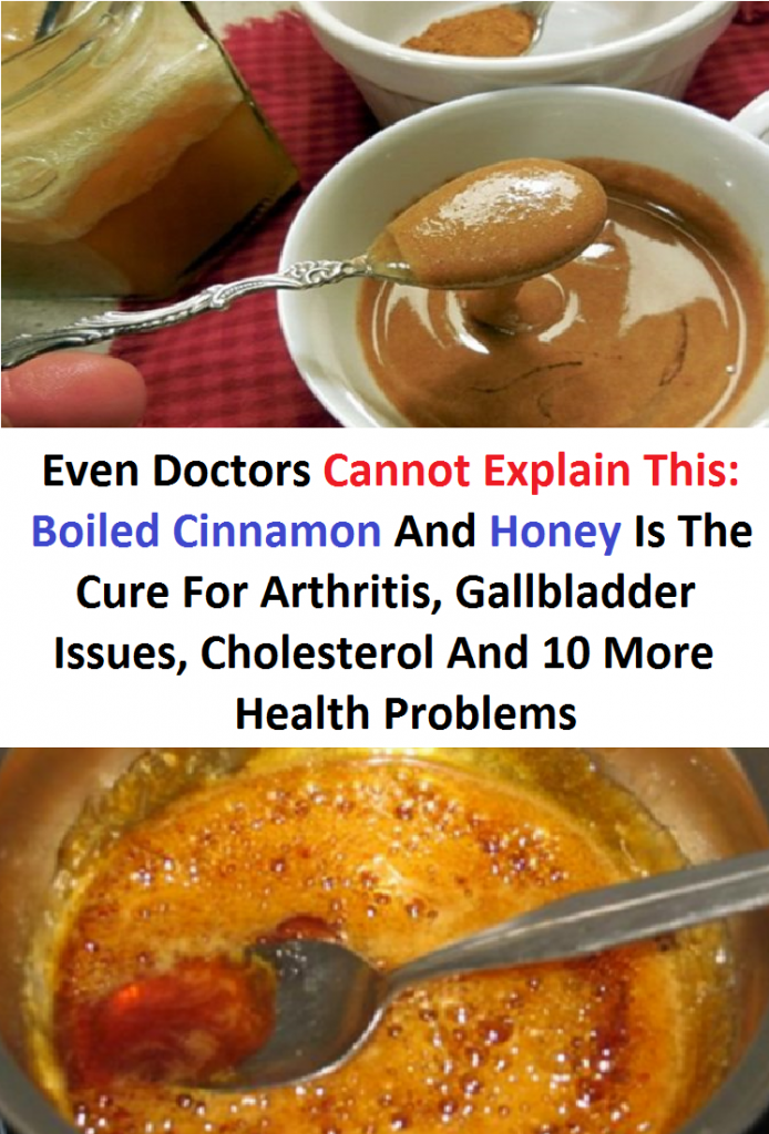 Even Doctors Cannot Explain This: Boiled Cinnamon And Honey Is The Cure For Arthritis, Gallbladder Issues, Cholesterol And 10 More Health Problems