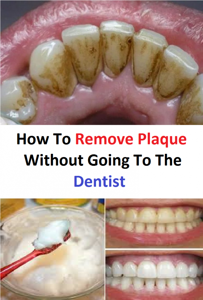 How To Remove Plaque Without Going To The Dentist