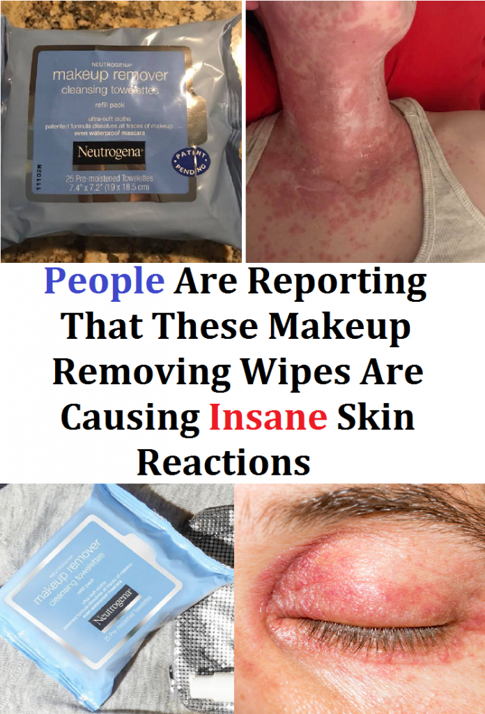 People Are Reporting That These Makeup Removing Wipes Are Causing Insane Skin Reactions