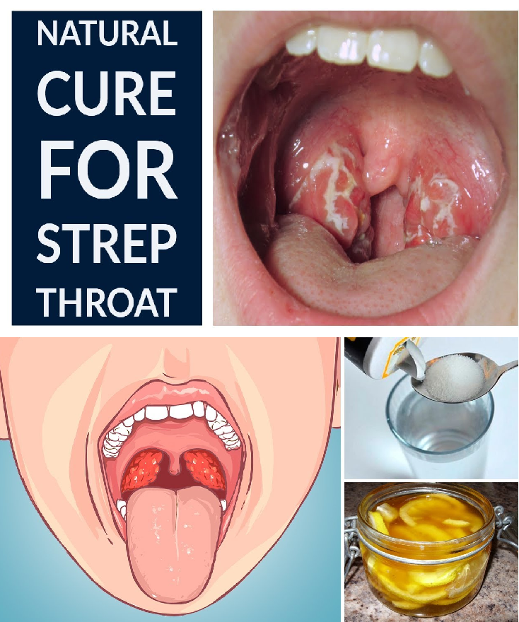 8 Effective Natural Home Remedies To Treat A Strep Throat Infection