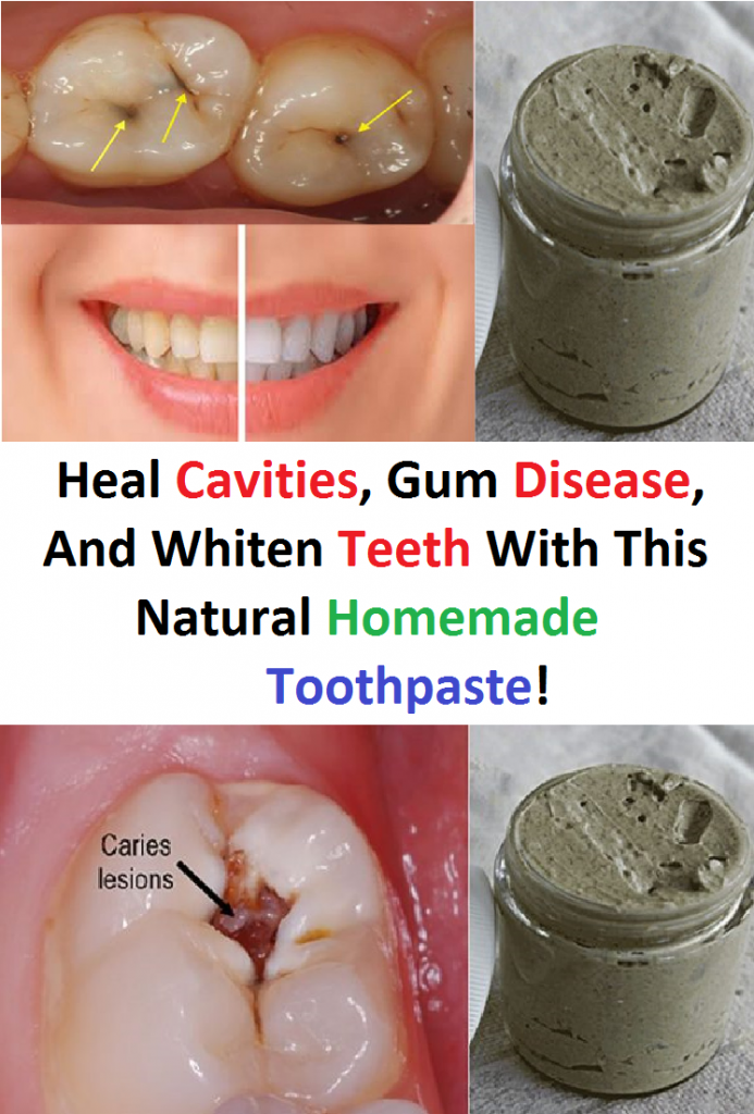 Heal Cavities, Gum Disease, And Whiten Teeth With This Natural Homemade Toothpaste!