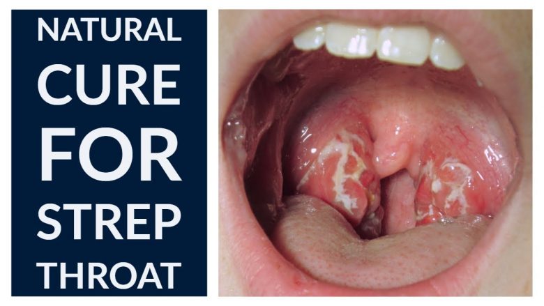 8 Effective Natural Home Remedies To Treat A Strep Throat ...
